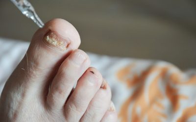 Achieve Lasting Comfort with Professional Ingrown Toenail Treatment in Jacksonville, FL