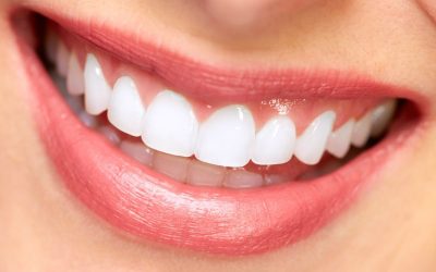 The Advantages of Teeth Whitening in New Lenox